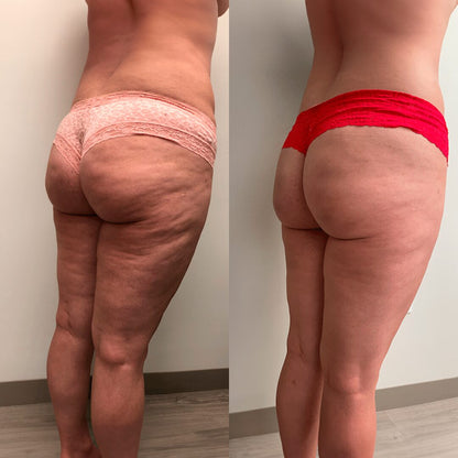 CelluLift™
