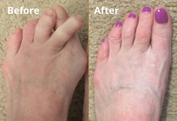 BunionBalance™ – Realign Toes