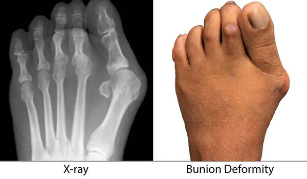 BunionBalance™ – Realign Toes